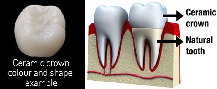 image of a tooth with a ceramic crown