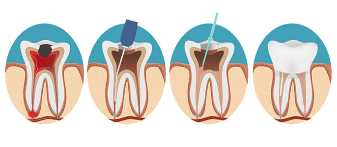 an illustration of tooth healing