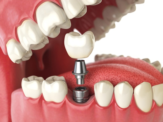 an illustration of a dental implant