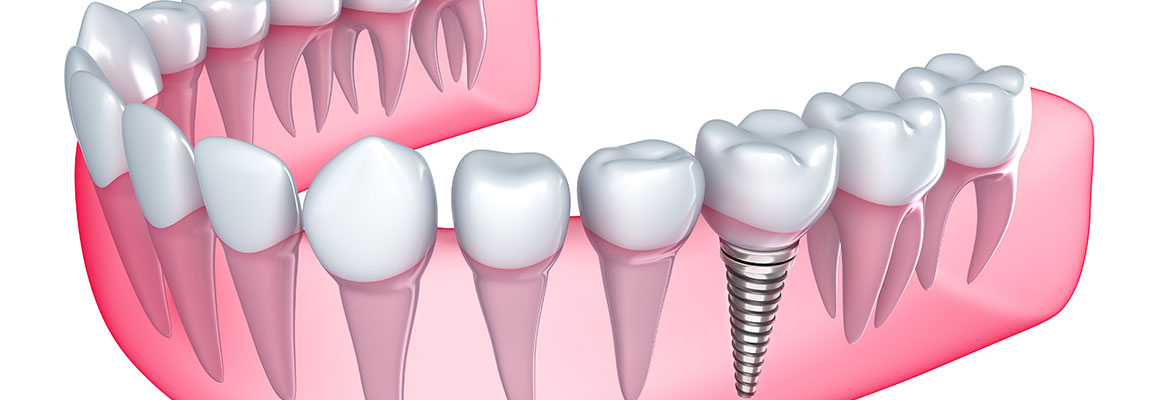 an illustration of a dental implant