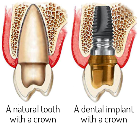 an illustration of a natural tooth and a dental implant