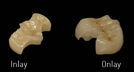 image of a tooth with inlay and onlay