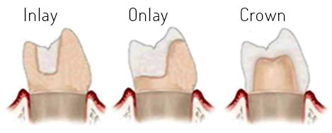 image of a tooth with inlay and onlay