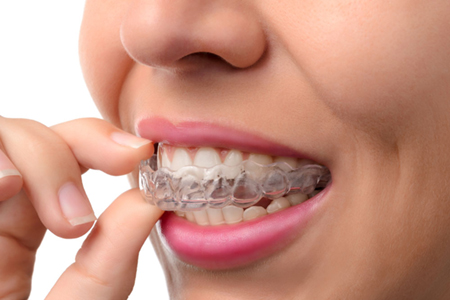 image of a teeth with an invisalign application