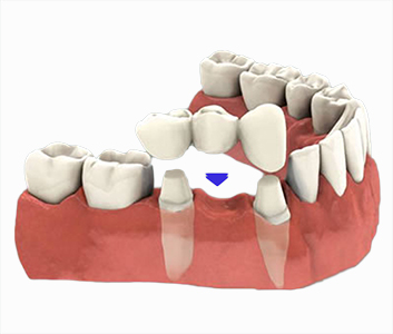 an illustration of tooth bridge