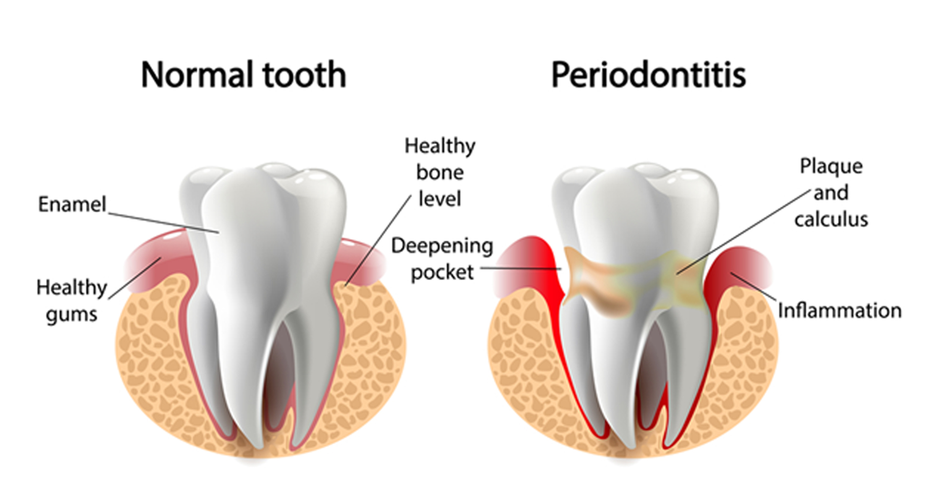 an illustration of a normal tooth and periodontitis