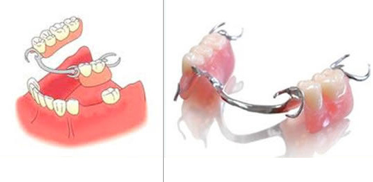 a photo and illustration of dentures