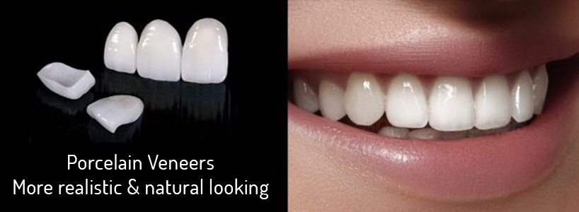 image of veneers applied to teeth